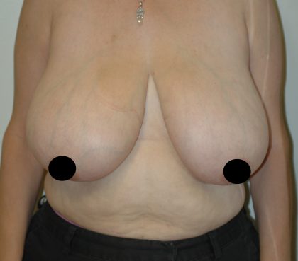 Vertical Breast Reduction Before & After Patient #2136