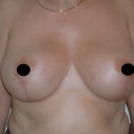 Vertical Breast Reduction Before & After Patient #2136