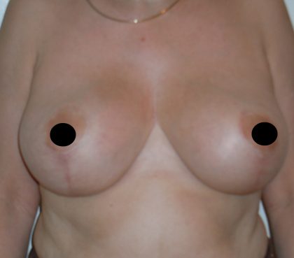 Vertical Breast Reduction Before & After Patient #2136