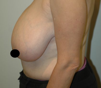 Vertical Breast Reduction Before & After Patient #2136