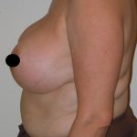 Vertical Breast Reduction Before & After Patient #2136