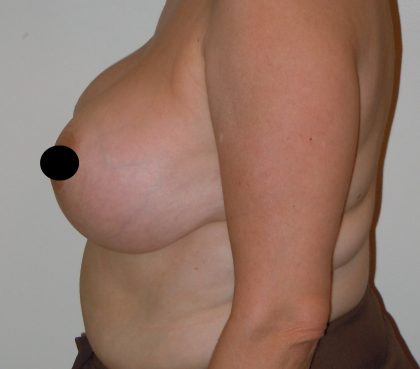 Vertical Breast Reduction Before & After Patient #2136