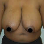 Vertical Breast Reduction Before & After Patient #2137