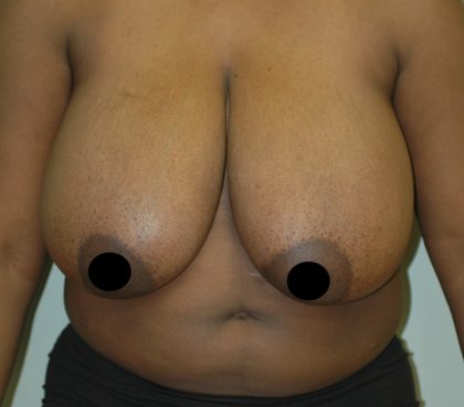 Vertical Breast Reduction Before & After Patient #2137