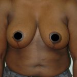 Vertical Breast Reduction Before & After Patient #2137