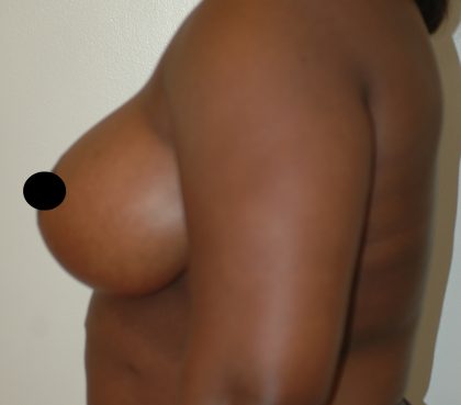 Vertical Breast Reduction Before & After Patient #2137