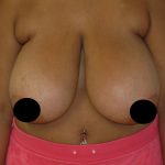 Vertical Breast Reduction Before & After Patient #2138