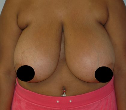 Vertical Breast Reduction Before & After Patient #2138