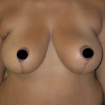 Vertical Breast Reduction Before & After Patient #2138