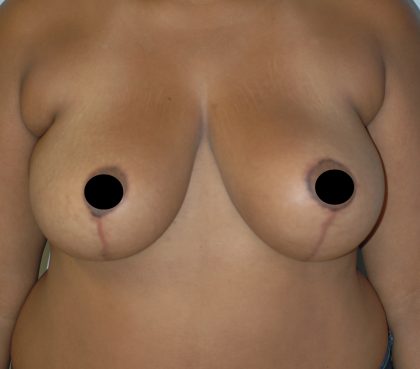 Vertical Breast Reduction Before & After Patient #2138