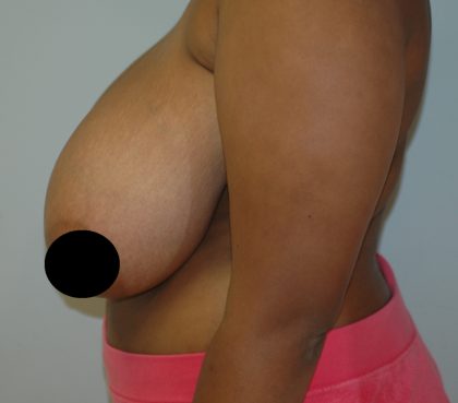 Vertical Breast Reduction Before & After Patient #2138