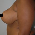 Vertical Breast Reduction Before & After Patient #2138