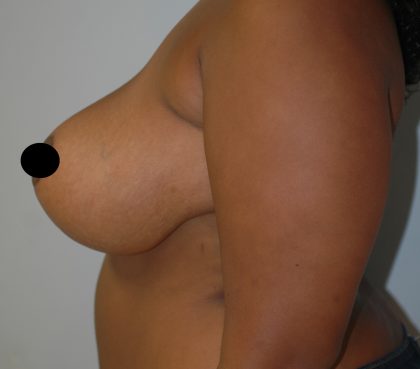 Vertical Breast Reduction Before & After Patient #2138