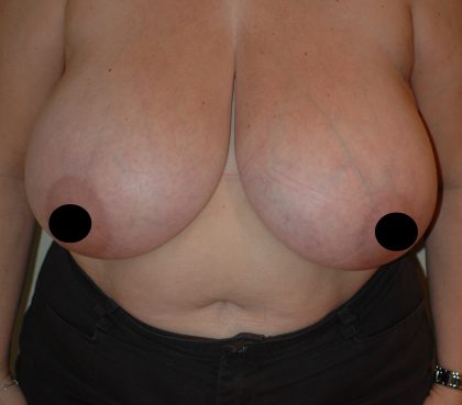 Vertical Breast Reduction Before & After Patient #2179