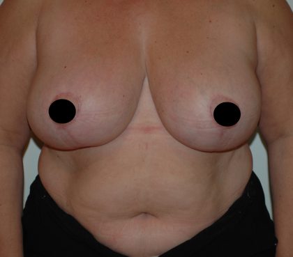 Vertical Breast Reduction Before & After Patient #2179