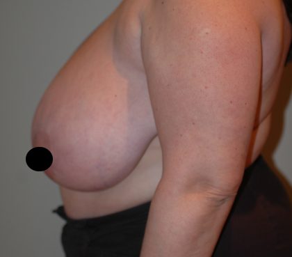 Vertical Breast Reduction Before & After Patient #2179