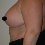 Vertical Breast Reduction Before & After Patient #2179