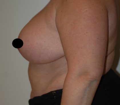 Vertical Breast Reduction Before & After Patient #2179