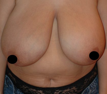 Vertical Breast Reduction Before & After Patient #2180