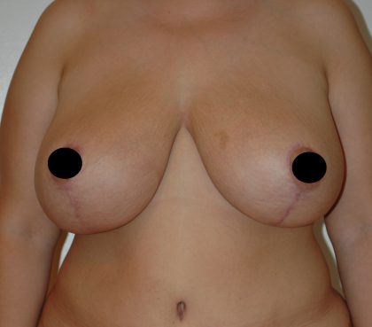 Vertical Breast Reduction Before & After Patient #2180