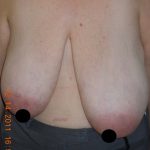 Vertical Breast Reduction Before & After Patient #2182