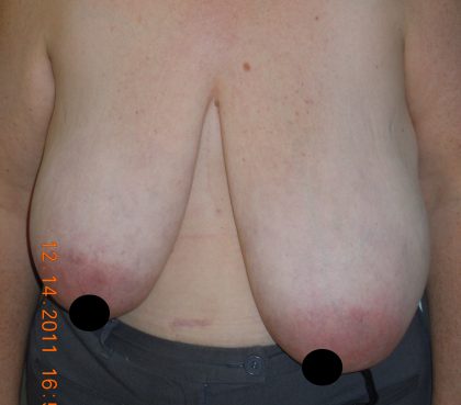 Vertical Breast Reduction Before & After Patient #2182