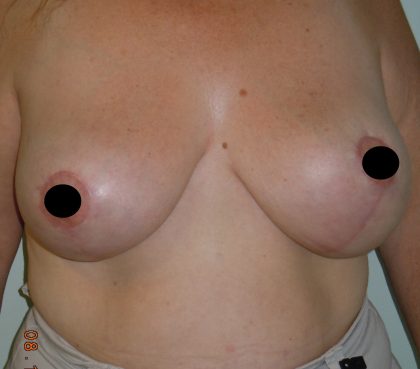 Vertical Breast Reduction Before & After Patient #2182