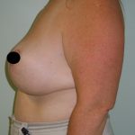 Vertical Breast Reduction Before & After Patient #2182