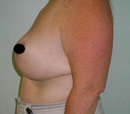 Vertical Breast Reduction Before & After Patient #2182